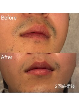 エピノン 山口岩国店(Epinon)/顔脱毛 ビフォーアフター