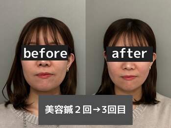 オアソラ(oasora)の写真/EMS美容鍼(電気＋鍼50本)でスッキリ小顔へ◎鍼と電気の力でむくみ・たるみ改善。小顔リフトアップへ◎