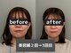 オアソラ(oasora)の写真/EMS美容鍼(電気＋鍼50本)でスッキリ小顔へ◎鍼と電気の力でむくみ・たるみ改善。小顔リフトアップへ◎