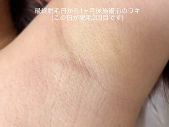 ピミル(PIMIL)/1ヶ月後のワキ(施術前）