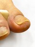 【巻き爪補整】男性にも◎看護師がする巻爪矯正(片方の足の親指)ネイルケア込