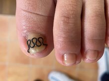 フットメンテ 巻き爪矯正センター 南浦和/巻き爪矯正　上面