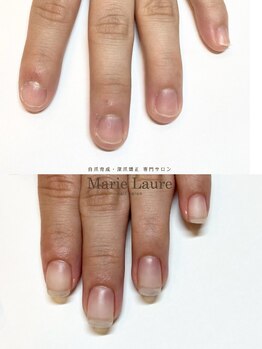 マリーロール 梅田店(Marie Laure)/自爪育成/深爪矯正/ネイルケア