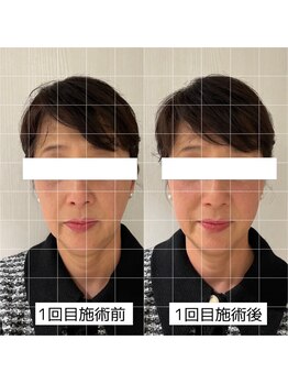 ヴィーライン 大阪梅田院(VeLine)/鍼灸／美容鍼／小顔／大阪／梅田