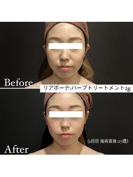 ミエル 神戸店(Miel)/リアボーテハーブトリートメント