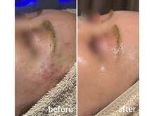 シェリーミル(Cherie Miru)/陶肌トリートメントBefore/After