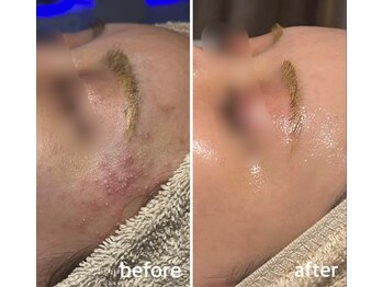 シェリーミル(Cherie Miru)/陶肌トリートメントBefore/After