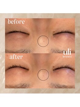 ウリ(uli beauty)/比較写真