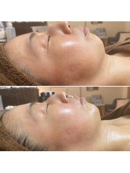 コルッソ(CoLusson.)/ホワイトスノーピール