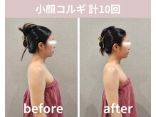 フェリシア(Felicia)/【小顔コルギ】計10回の結果