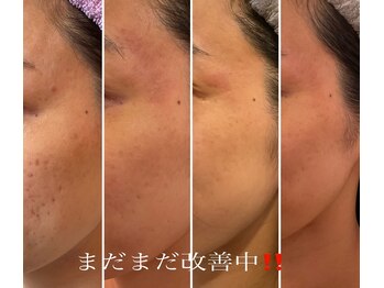 トータルビューティーサロン 凛/肌悩みの改善
