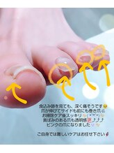 ノーブルフルール(Noble fleur)/食い込み爪スッキリ巻き爪予防へ