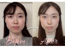 アシュネ(Axiune)/30代★小顔矯正”エラ張り改善”