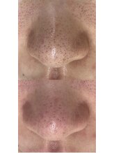 ネイルサロン きらら 藤沢本店/毛穴ケア　黒ずみ徹底ケア