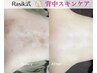 【背中ニキビ・色素沈着】長年の背中ニキビを根本改善【初回体験 ¥3,980】