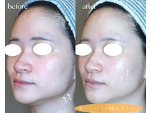 岩川治療院/食いしばりの改善！