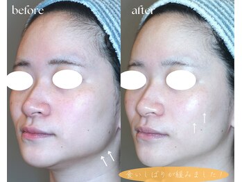 岩川治療院/食いしばりの改善!