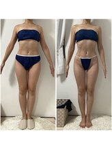 ポラス(Polus)/キャビ×ラジオ波（全身）