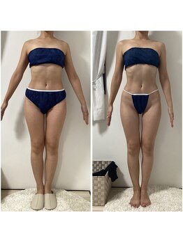 ポラス(Polus)/キャビ×ラジオ波（全身）