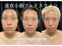 ビフォーアフター写真＆ブログ掲載中!【小顔×痩身/ブライダル】