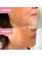 リシェル(Richelle)/【GREENPEEL5days】