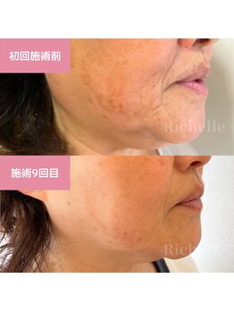 リシェル(Richelle)/【GREENPEEL5days】