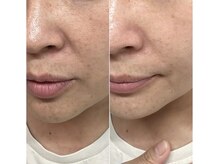 マヴィ 藤井寺店(MavY.)/頬のたるみケア&毛穴撲滅