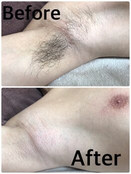 ブラジリアンワックス脱毛サロン ルラ 横浜(Lula)/男性にも大人気！