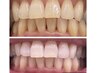 歯のセルフホワイトニング15分×2セット ￥4980