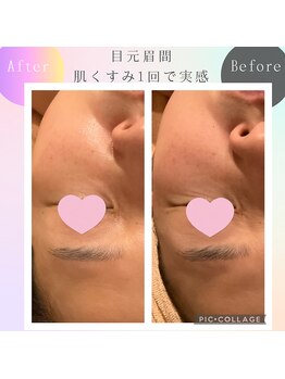 パルティノ 高崎店/エクソソーム＋備長炭マスク