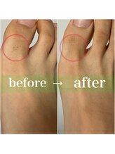 ルシャトン(Le Chaton)/足指脱毛