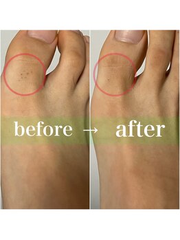 ルシャトン(Le Chaton)/足指脱毛