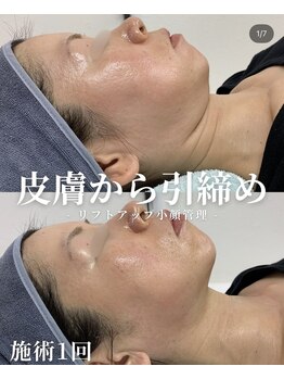 リメイク 銀座(REMAKE)/リフトアップ小顔フル工程