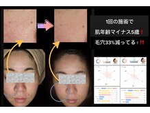 ナースセレクトサロン(Nurse select salon)/1回で－５歳！毛穴32％減！