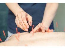 ライフサロン 天神(Life Salon)/ボディ鍼◎深部のこり改善に