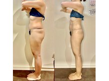 カルナ(CARNA)/【痩身】セルライトゼロ2