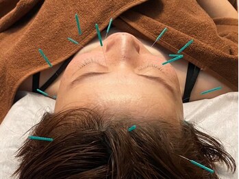 ネウラ 高田馬場院(neula)の写真/【美肌×小顔】鍼灸師による「美容はり」でハリ艶UP・美白ケアが叶う☆リフトアップ効果で横顔美人に♪