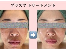 リーシャ(Reesha)/プラズマトリートメント