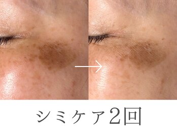 レイミー(reimee)/【シミケア2回】Before/ After
