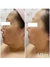 トータルビューティサロン クイーン(Queen)/ほほ・フェイスラインのたるみ