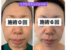 プリュネル(Prunelle)/プラズマシャワー