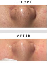 メルディアナ(MAR DIANA)/クリスタル毛穴洗浄