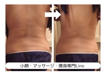 リノ(Lino)/★キャビテーション★