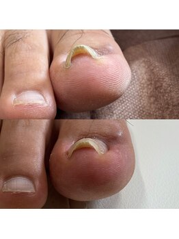 リリ(lili)/巻き爪矯正3回目(右親指)