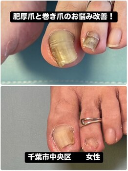 巻き爪じゅん 千葉駅前店/巻き爪・肥厚爪のお悩みが改善！
