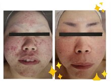 ナースセレクトサロン(Nurse select salon)/人生が変わる　肌荒れ改善
