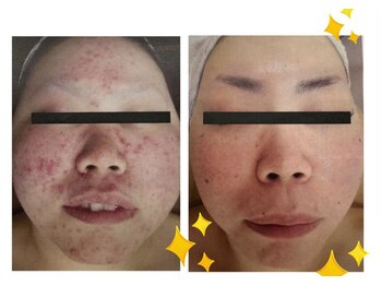 ナースセレクトサロン(Nurse select salon)/人生が変わる　肌荒れ改善