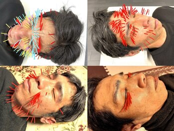 とだ鍼灸院の写真/浅層~深層にある痛みを感じる箇所“トリガーポイント”に鍼施術! 1回で辛い痛みを大幅減少できる全身鍼◎