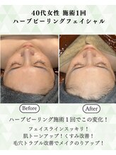 シーフェイス 横浜店(SEE FACE)/毛穴肌質改善ハーブピーリング