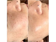 エッセンシア(ESSENCIA)の雰囲気(【ジュエリーピール】1回でこのツヤ!憧れの水光肌に♪敏感肌◎)